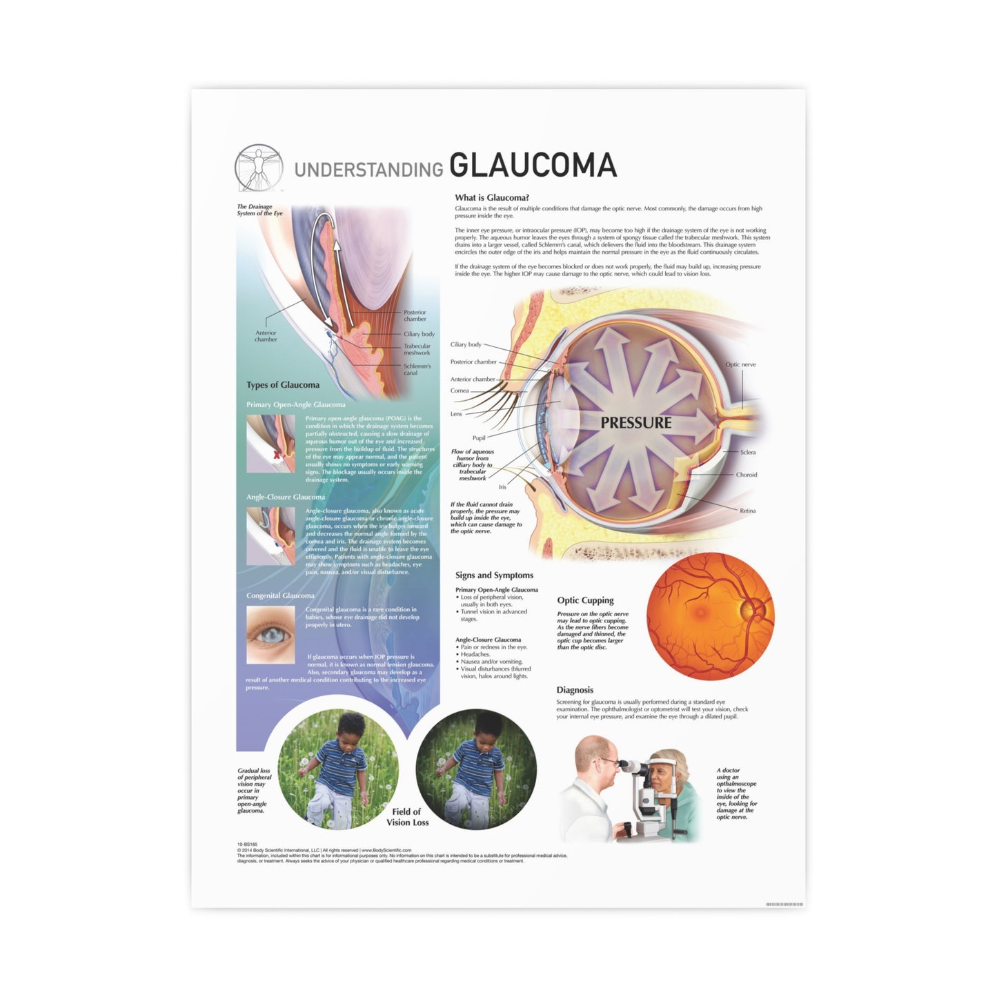 Understanding Glaucoma
