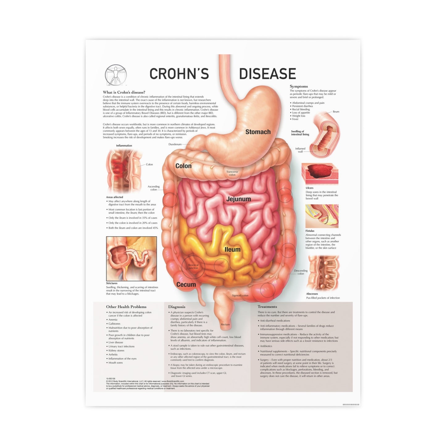 Chron's Disease
