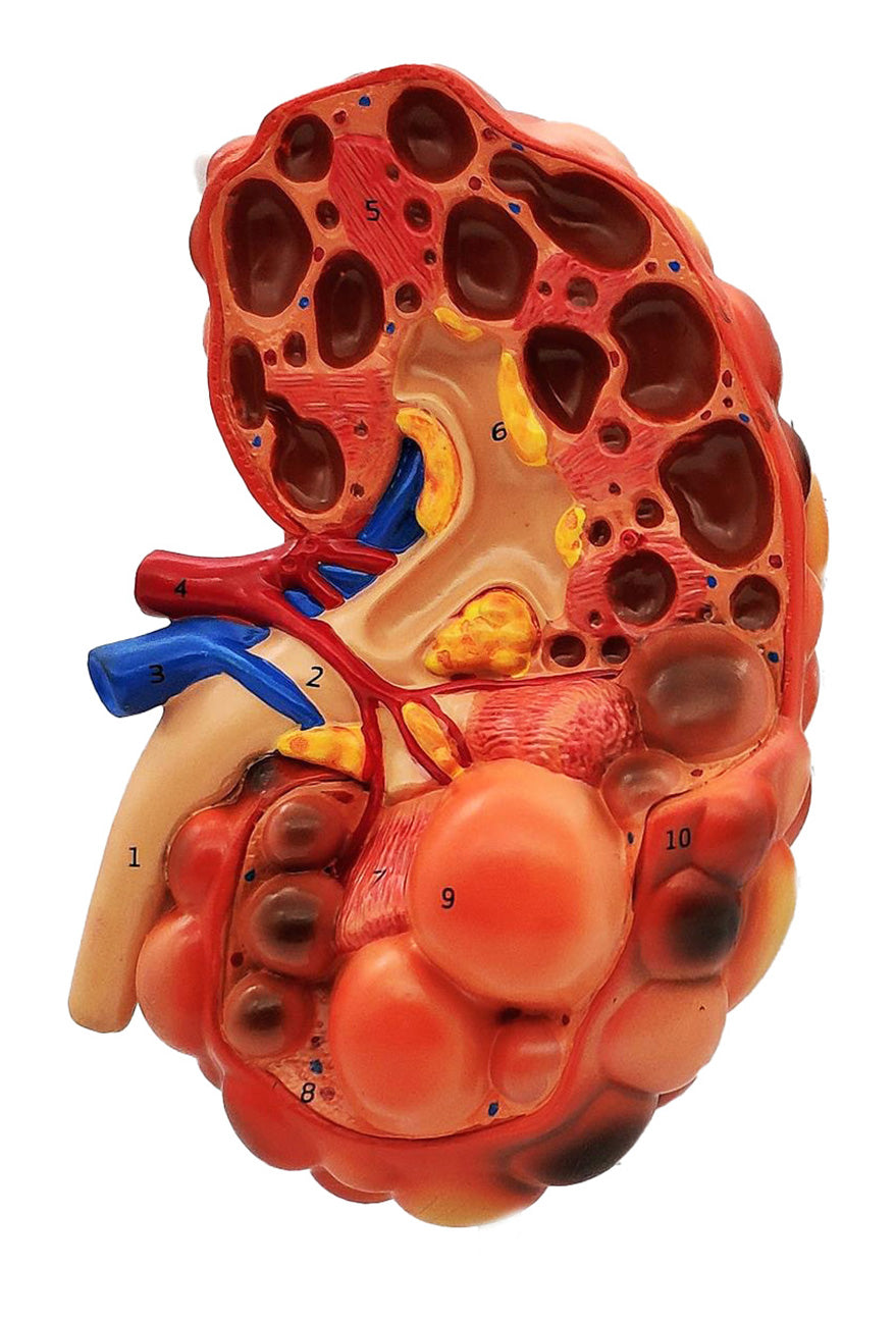 ADPKD Kidney