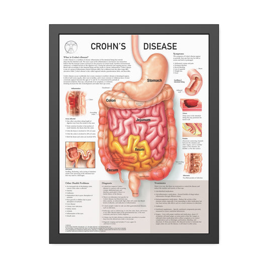 Chron's Disease