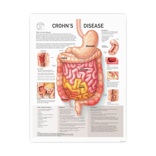 Chron's Disease