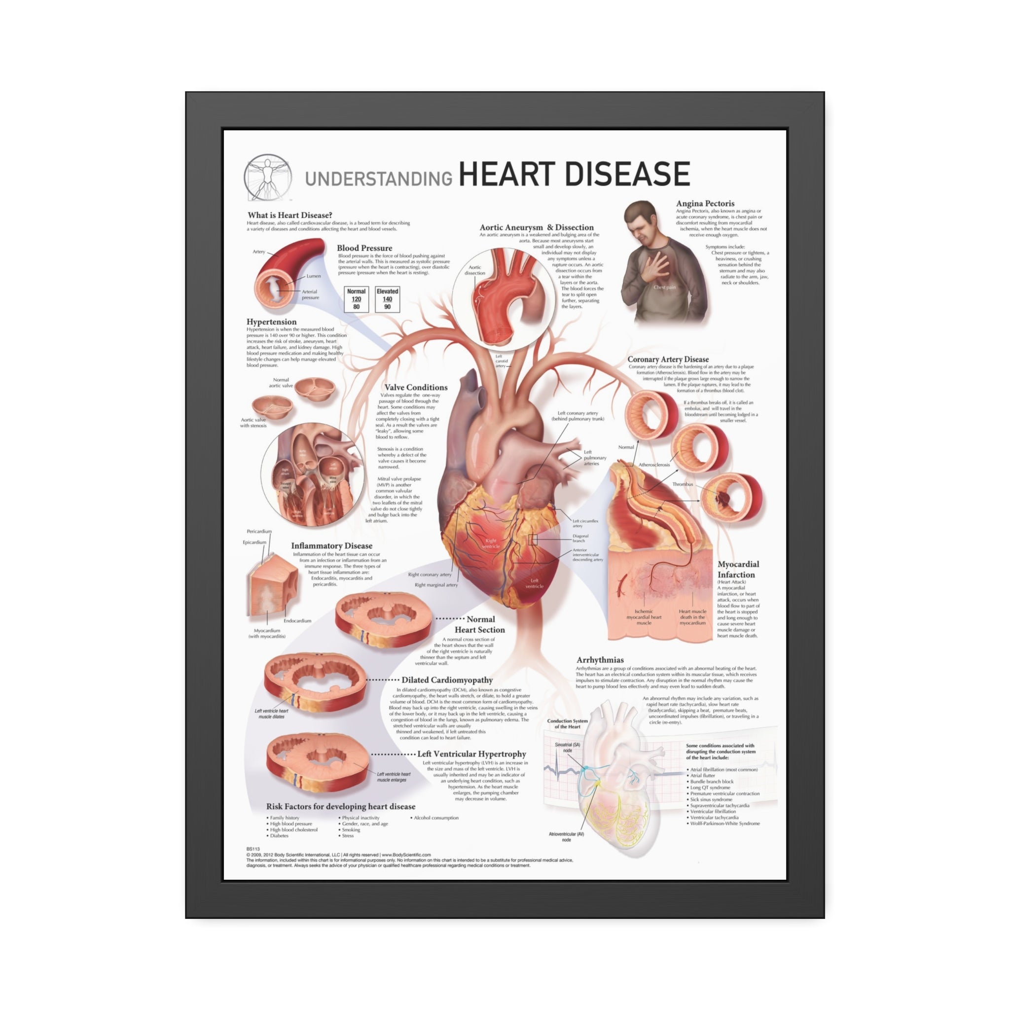 Understanding Heart Disease – Body Scientific